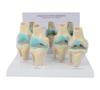 CAIONPLE Kit de Rodilla Modelo de Anatomía de Osteoartritis con Tarjeta de Clave Educativa Modelo de Rodilla de 4 Etapas Material Didáctico Ortopédico