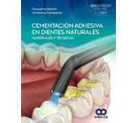 cementación adhesiva en dientes naturales