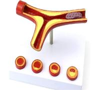 CHROX Modelo Anatómico De PVC, Modelo De Arteriosclerosis, Modelo De Arteriosclerosis, Modelo De Trombo De Enfermedad Arterial Coronaria, Modelo De Demostración De Enseñanza Médica
