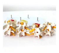 Comparación de la Columna Lumbar con Enfermedad en 4 Etapas Modelo, Modelo de Lesión de Columna Lumbar Desmontable, con Tarjeta Posterior en Inglés para Explicación en el Aula