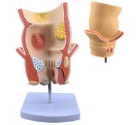COYEUX Modelo anatómico de patología Rectal, simulación de Enfermedad hemorroidal, Modelo de acné anorrectal, para anatomía intestinal Rectal, formación clínica, Material didáctico
