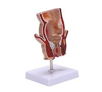 Cpolebev Modelo de AnatomíA, Modelo de LesióN de Hemorroides Rectales Humanos, FíStula de Hemorroides, Modelo de EnseñAnza de PatologíA