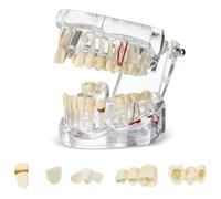 Cpolebev Modelo de Dientes Enfermos Tipodontos Dentales Modelo de Dientes de Implante con Dientes Removibles Demostración de Dientes Estándar del Dentista