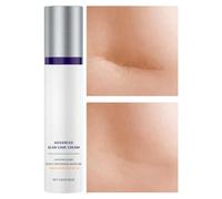 Crema Eliminadora De Cicatrices De Quemaduras | Crema Para Eliminar Queloide | SPF 30 Portátil Reductor de Queloides Hidratante para Recuperación Cutánea en Piel Adulta Corporal