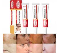 Crema para las Manchas de La Cara, Cremas para Quitar Manchas de La Cara, Crema Blanqueadora para Pecas, Elimina el Melasma Manchas Oscuras Aclara La Piel