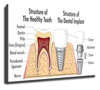 Dental Anatomy Poster Human Tooth Structure and Implant Diagram Educational Chart for Dentist Office or Classroom(Unframed,12x18inch(30x45cm))
