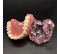 Dental Standard Teaching Teeth, Reparación de Sobredentadura Móvil con 4 Implantes Demostración para la Enseñanza Médica Modelo de Comunicación Médico-Paciente