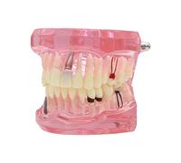 Dentalmall 1 pc Dental Implant Análisis Estudio Demostración Dientes Modelo # 2001 con Restauración rosa