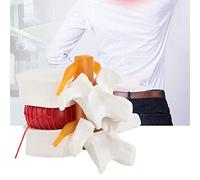 DEWIN Modelo de Columna Vertebral Lumbar, 1: 1.5 Modelo anatómico Humano de demostración de Columna Vertebral Lumbar, Modelo de Hernia de Disco Lumbar