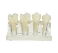 Didiseaon Modelo de Dientes Caries para Enseñanza de Higiene Bucal y Demostración Clínica, Material Abs, Muestra Tipos de Cavidades, Adecuado para Profesores y Asistentes