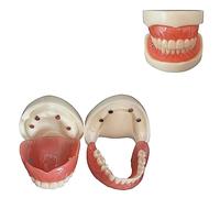 Dientes de implante dental, modelo de dentadura postiza de dientes desmontables, sobredentadura de boca completa con demostración de 4 implantes para enseñanza escolar, estudio, demostración modelo
