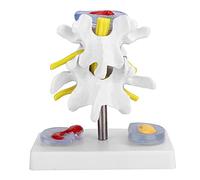 Disco Lumbar Anatómico, Modelo de Demostración de Modelo de Hernia Intervertebral Columna Lumbar Columna Vertebral Humana Material de Entrenamiento Escolar