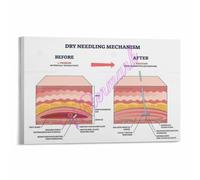 Dry Needle Poster Pain Neuromuscular Pathway Chart | Stimulates mechanoreceptors altering pain signal transmission at spinal cord level(Unframed,16x24inch(40x60cm))