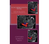 Ecocardiografia Fetal: Sindrome de Corazón Izquierdo Hipoplásico. Coartación y Estenosis aórtica.