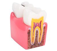 EIMSOAH Modelos de Estudio de Comparación de Caries Dentales, Modelo de Dientes para Educación de Anatomía Dental de Dentista con Modelo Transversal de Esmalte, Dentina, Pulpa, Cemento,