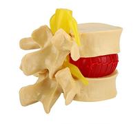 Estudio de modelo de demostración de hernia de disco lumbar 1:1.5 Aprenda la columna vertebral humana