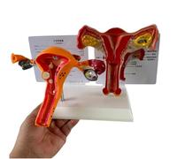 FHUILIJH B,Life Size, Modelo de Patología Anatómica del Útero Modelo de Anatomía Reproductiva y Ovárica Cambios Patológicos Útero Modelo Científico para Enseñanza