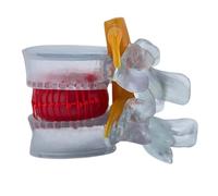 FHUILIJH Clear,5inch, Modelo Educativo de vértebra Lumbar con nervio, Disco intervertebral Lumbar removible, Columna Lumbar para enseñanza médica y exhibición