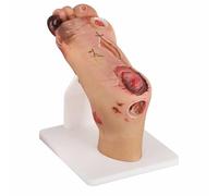 FHUILIJH Modelo de Cuidado del Pie Diabético, Modelo de Patología del Pie, Modelo de Úlcera Médica del Pie para la Enseñanza de Deformidades del Pie,Severe,15cm