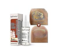 Fungal Nail Care Essence Foot Repair Essence Toe Whitening Treatment, Gel Anti-infectieux, 20 Ml