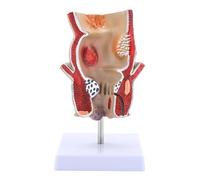 FytStycale Modelo de Patología del Recto Humano: Herramienta Científica para