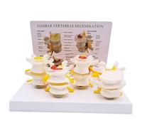 Genérico Modelo de columna vertebral humana, modelo comparativo de columna lumbar enferma en 4 etapas de las etapas de enfermedades del disco espinal, degeneración ósea, osteoporosis avanzada