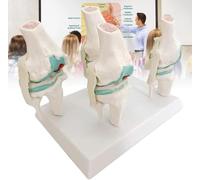 GFLCWYP Juego de modelos de articulación rodilla humana,modelo anatómico de rodilla patológica,muestra lesiones degenerativas de la rodilla en 4 etapas: estado normal y patológico osteoartrítico