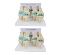 GIWFBQTR 2X Kit de Rodilla Modelo de Anatomía de Osteoartritis con Tarjeta de Clave Educativa Modelo de Rodilla de 4 Etapas Material Didáctico Ortopédico