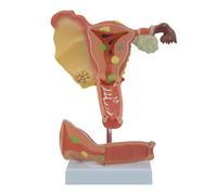 GPDNBIEU, Modelo de útero patológico, for demostración docente investigación en comunicación médico-paciente