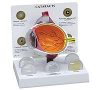 GPI Anatomicals Ojo con catarata