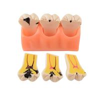 GTHTUHFD Desmontaje De Dientes, Desmontaje Cuádruple, Modelo, Caries, Herramientas De Visualización De Evolución para Enseñanza Y Estudio.