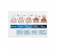 Gum Disease Stage Poster Periodontal Progression Chart Oral Health Educational Wall-Art for Office School Patient Education Home Decor(Framed,12x18inch(30x45cm))