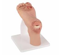 Herramienta de formación sobre úlceras en los pies, modelo de pie diabético, conjunto de réplicas patológicas en fase leve o grave, anatómicamente preciso para el estudio de deformidades y heridas