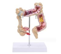 Herramientas Didácticas para La Patología del Colon Humano - Modelo Anatómico Médico de Patología Colorrectal - Estudio A 25 Cm