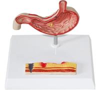 HGAYUBDV Modelo de anatomía gástrica Humana, Modelo de patología de estómago Perforado, Herramienta de enseñanza y Aprendizaje sobre patología estomacal, Gastritis y úlceras.