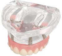 HGAYUBDV Modelo de Dientes dentales, Modelo de implante Dental con prótesis de Puente, Dientes Adultos, mandíbula Superior, 4 implantes, Puente con Titanio, Base Transparente.
