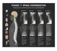 HGETJOHXEM Spinal Degeneration Chart Level Demonstration Vertebral Subluxation Anatomy Educational Poster Canvas Print Wall-Art for Chiropractic Office Decor(Framed,16x24inch(40x60cm))