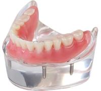 HGJHJJHK Modelo de restauración Dental de Dientes dentales con 4 implantes sobredenture implantes de precisión Inferior demostración
