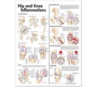 Hip and Knee Inflamaciones Anatómicas Gráfico