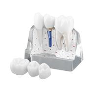 Hoite Modelo de implante dental transparente con coronas de resina, implantes metálicos, pilares, piezas separables, 4 imanes, puente de seguridad.