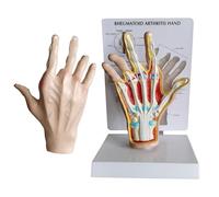 HUIBBGO Modelo de Palma Humana enferma. Anatomía de la Palma reumática. Mano enferma. Modelo de patología de la Mano. Modelo de Mano con Artritis reumatoide. Modelo de articulación de la m