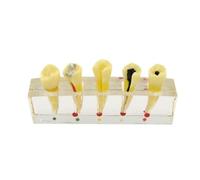 HUIBBGO Modelo de Tratamiento de endodoncia Dental: 5 etapas del procedimiento de conducto radicular. Modelos de Estudio comparativo de Enfermedades de Dientes incisivos, Segundos Premolar