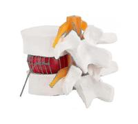 Human Anatomy Model for Demonstrating Lumbar Disc Herniation of the Lumbar Spine