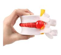 Human Lumbar Disc Herniation Demonstration Model of Lumbar Vertebral Spine