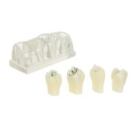 ibasenice Modelo de Dientes de Anatomía Oral para Demostración y Educación en Salud Cavidad de Caries, Material Abs Resistente, Adecuado para Uso en Aula y Comunicación Pacientes