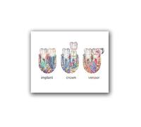 Implante de dientes arte corona Dental impresión dentista regalo anatomía los médico cuadro sobre lienzo for pared decoración clínica(PC1016,40x50 cm No Frame)
