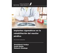 Implantes cigomáticos en la rehabilitación del maxilar atrófico: Una revisión exhaustiva