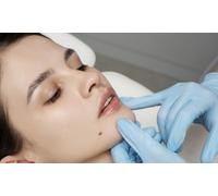 Infiltración de 2 viales de tratamiento facial de relleno dérmico y blanqueamiento dental LED