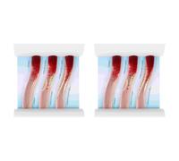 Iyalezirk 2X Modelo Dinámico de Vasos Sanguinos Modelo de Contraste de Bloqueo Cardiovascular Modelo de Trombosis para la Explicación de la Enseñanza