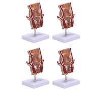 Jnchdghwa 4X Modelo de Anatomía, Modelo de Lesión de Hemorroides Rectales Humanos, Fístula de Hemorroides, Modelo de Enseñanza de Patología